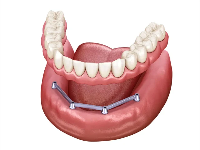 https://dentistdana.codingforum.ro/wp-content/uploads/2025/04/protetica3-640x480.webp